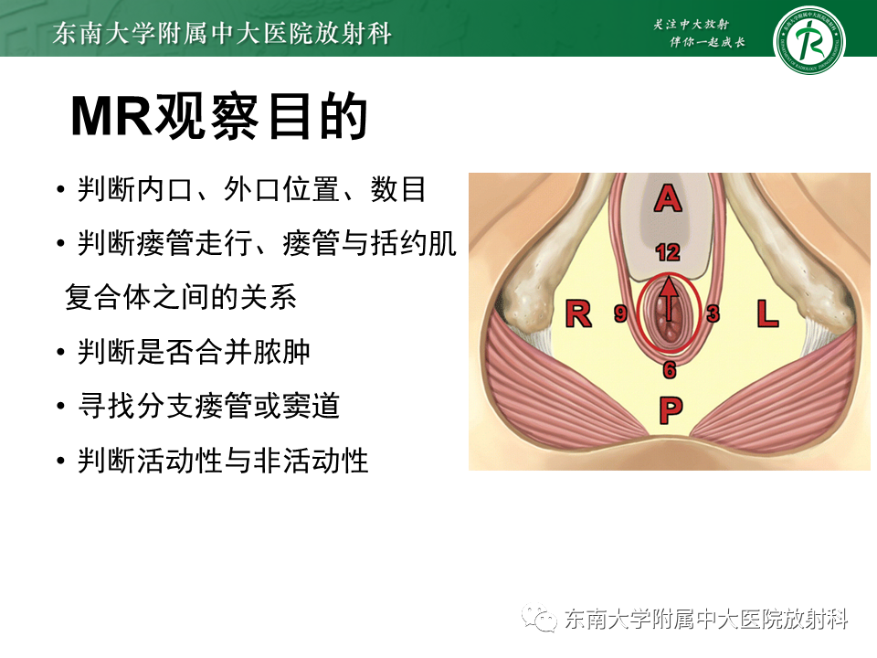 影像PPT - 【PPT】肛瘘的MR诊断-13