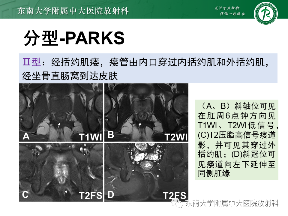 影像PPT - 【PPT】肛瘘的MR诊断-21