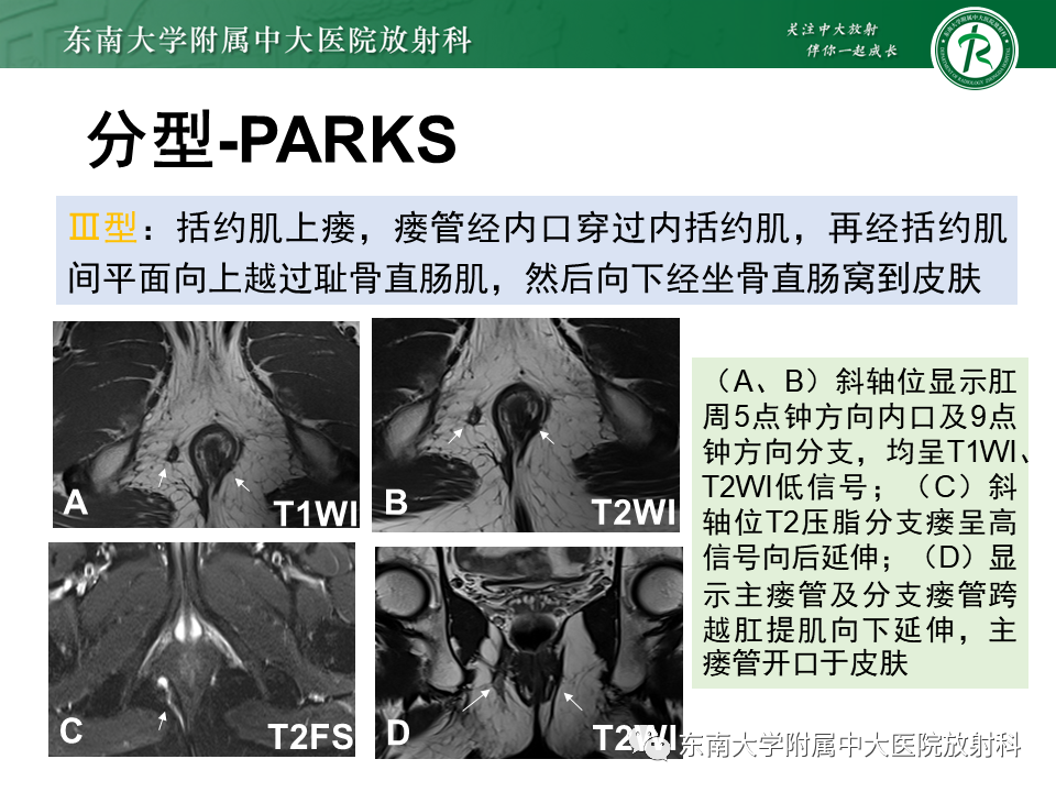 影像PPT - 【PPT】肛瘘的MR诊断-24