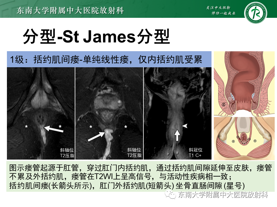 影像PPT - 【PPT】肛瘘的MR诊断-29
