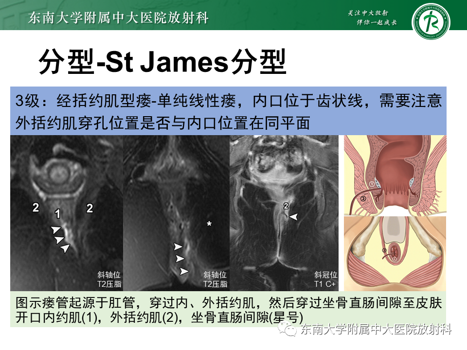 影像PPT - 【PPT】肛瘘的MR诊断-31