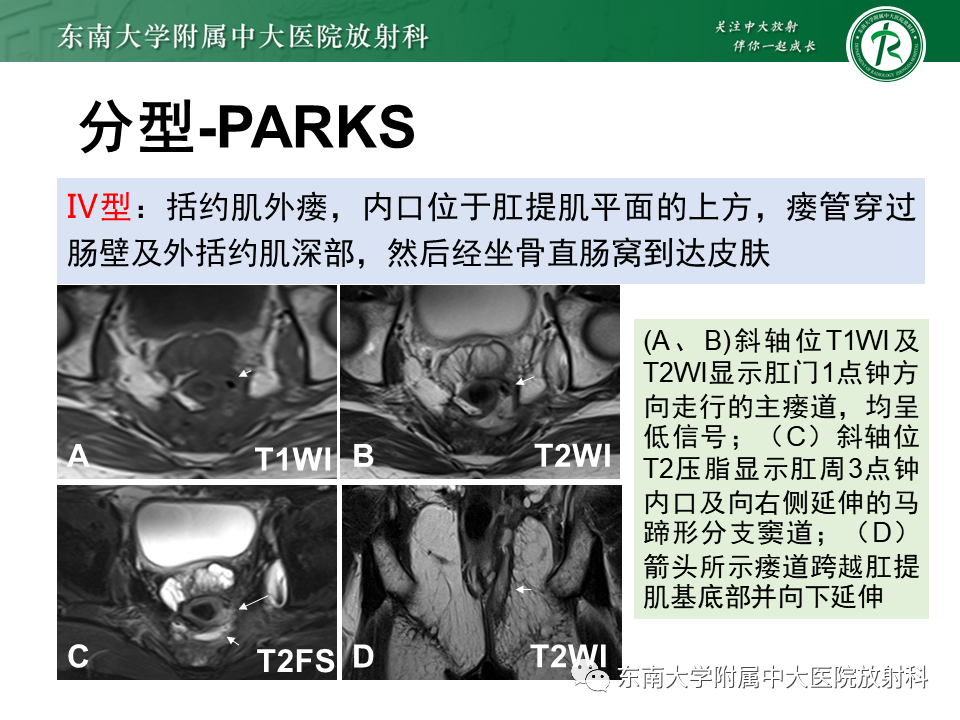 影像PPT - 【PPT】肛瘘的MR诊断-26