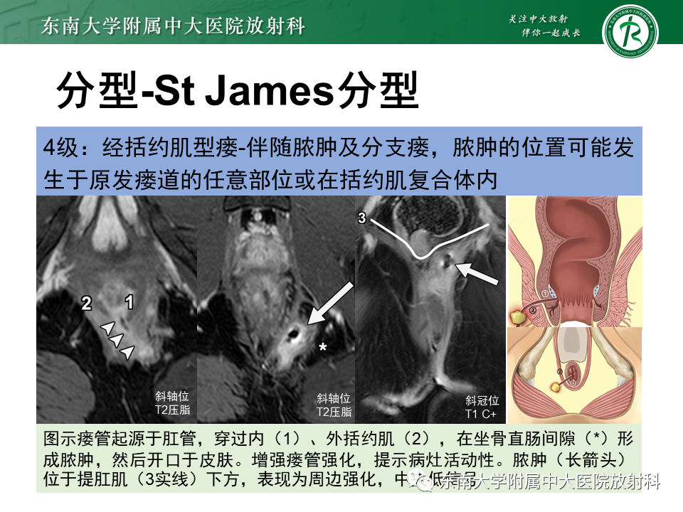 影像PPT - 【PPT】肛瘘的MR诊断-32