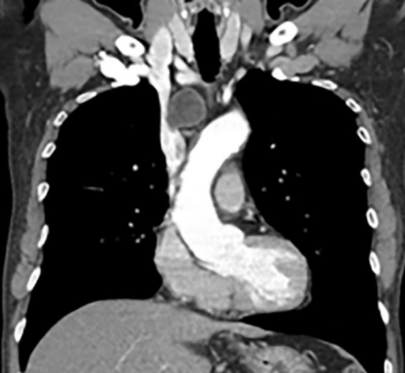 影像PPT - 【病例】纵膈成熟囊性畸胎瘤1例CT影像-5 影像PPT - 【病例】纵膈成熟囊性畸胎瘤1例CT影像-5