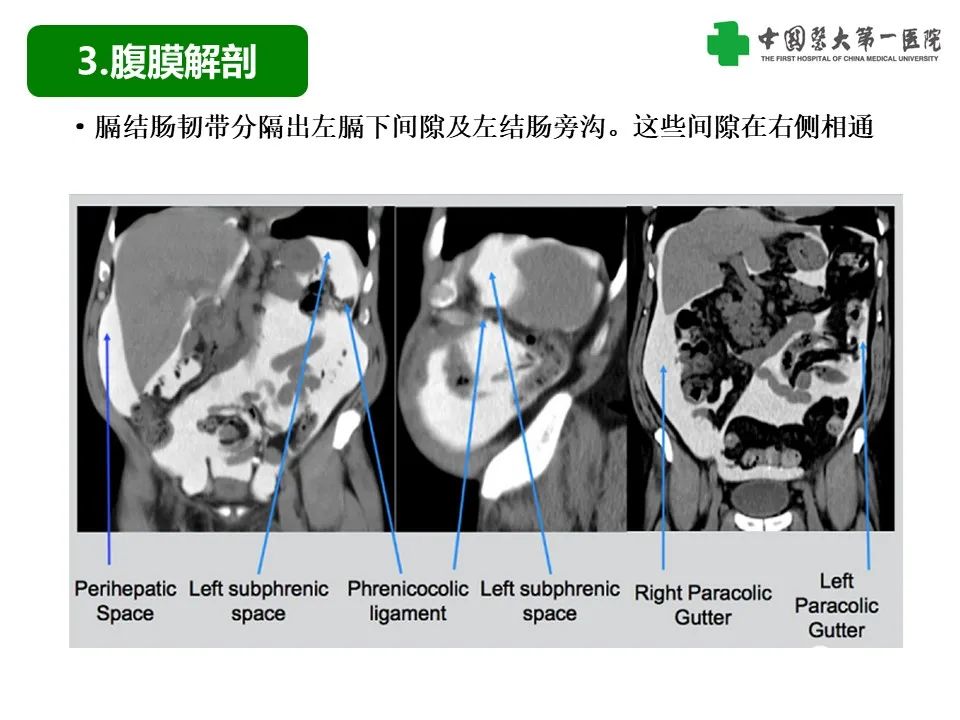 影像PPT - 【PPT】腹腔内游离气体从哪来？如何根据腹膜解剖确定穿孔位置-11