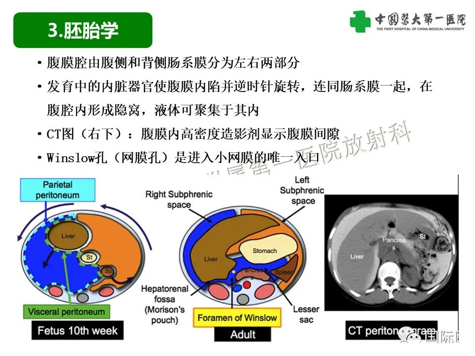 影像PPT - 【PPT】腹腔内游离气体从哪来？如何根据腹膜解剖确定穿孔位置-8