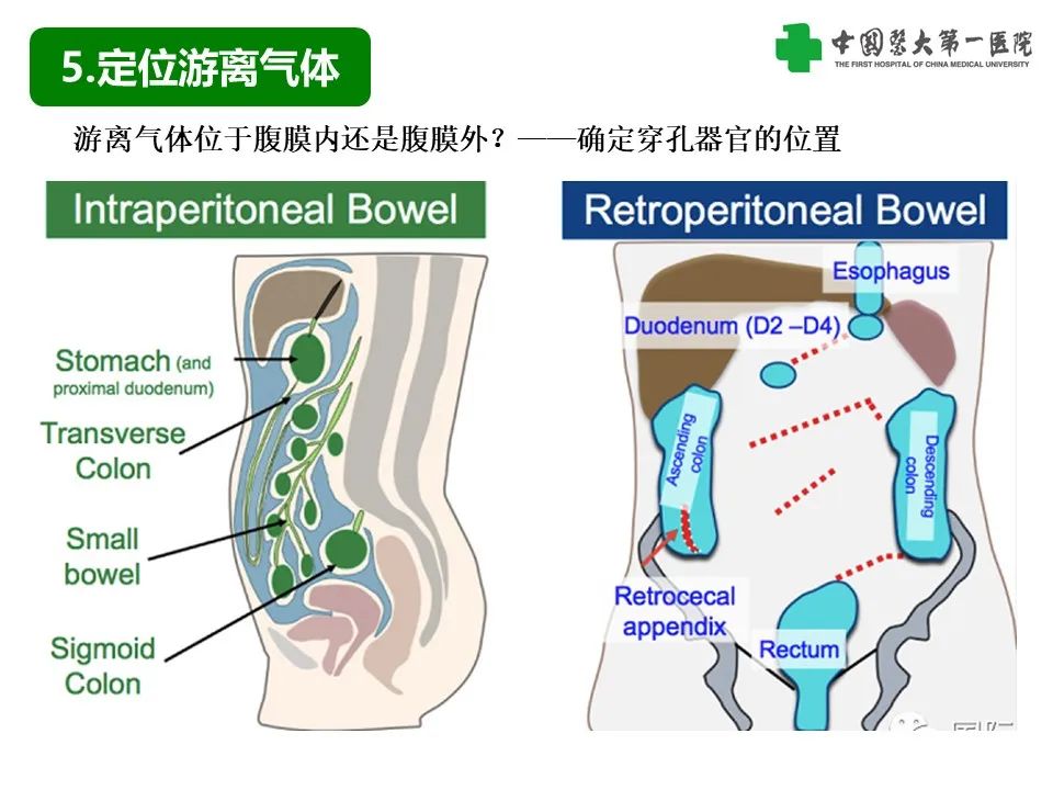 影像PPT - 【PPT】腹腔内游离气体从哪来？如何根据腹膜解剖确定穿孔位置-15