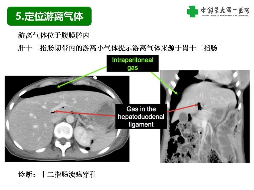影像PPT - 【PPT】腹腔内游离气体从哪来？如何根据腹膜解剖确定穿孔位置-19
