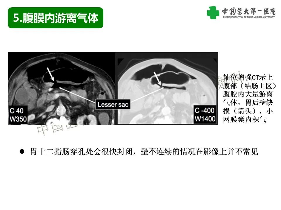 影像PPT - 【PPT】腹腔内游离气体从哪来？如何根据腹膜解剖确定穿孔位置-22