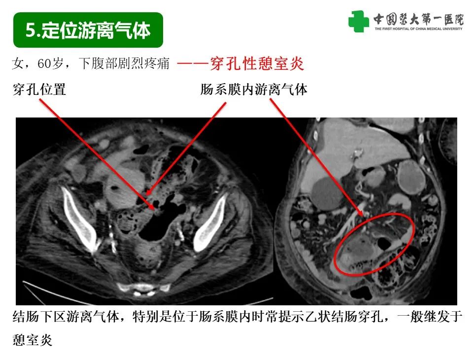 影像PPT - 【PPT】腹腔内游离气体从哪来？如何根据腹膜解剖确定穿孔位置-23