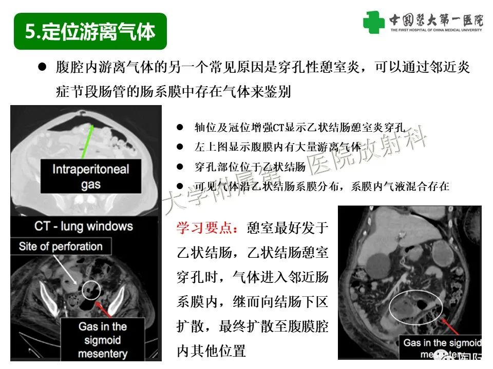 影像PPT - 【PPT】腹腔内游离气体从哪来？如何根据腹膜解剖确定穿孔位置-24
