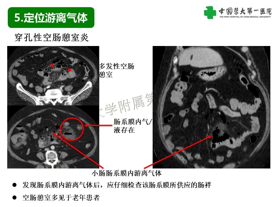 影像PPT - 【PPT】腹腔内游离气体从哪来？如何根据腹膜解剖确定穿孔位置-27
