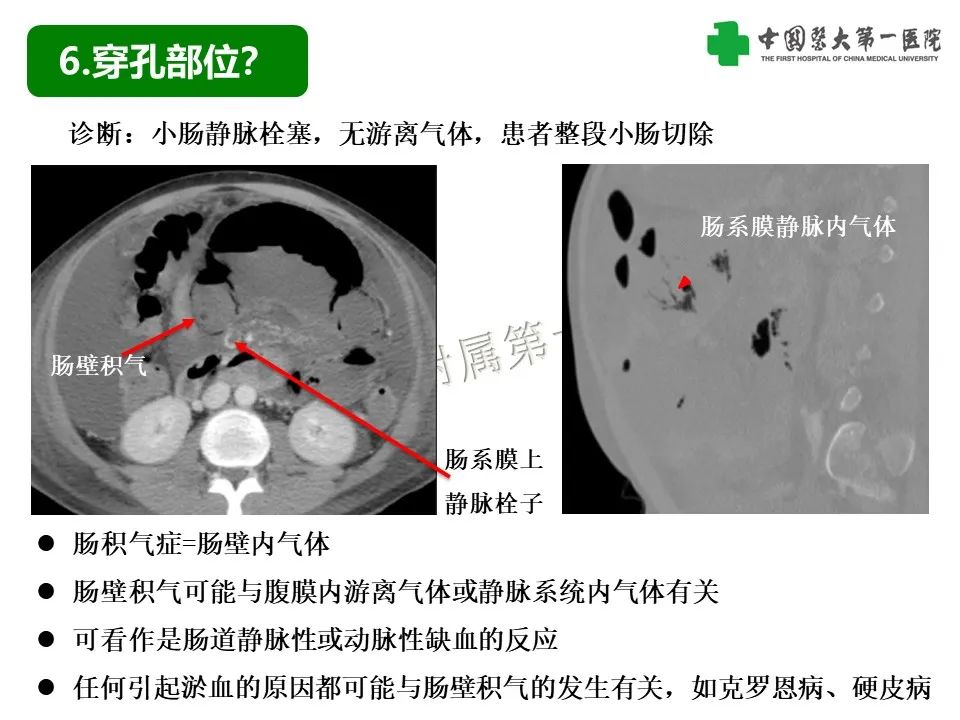 影像PPT - 【PPT】腹腔内游离气体从哪来？如何根据腹膜解剖确定穿孔位置-31