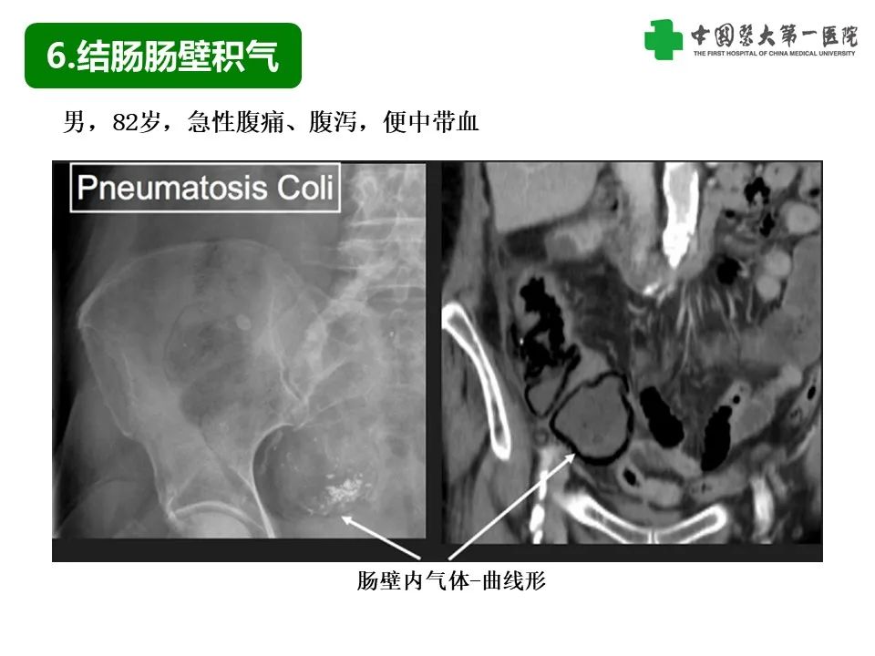 影像PPT - 【PPT】腹腔内游离气体从哪来？如何根据腹膜解剖确定穿孔位置-32