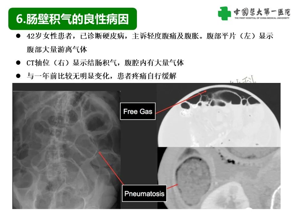 影像PPT - 【PPT】腹腔内游离气体从哪来？如何根据腹膜解剖确定穿孔位置-34