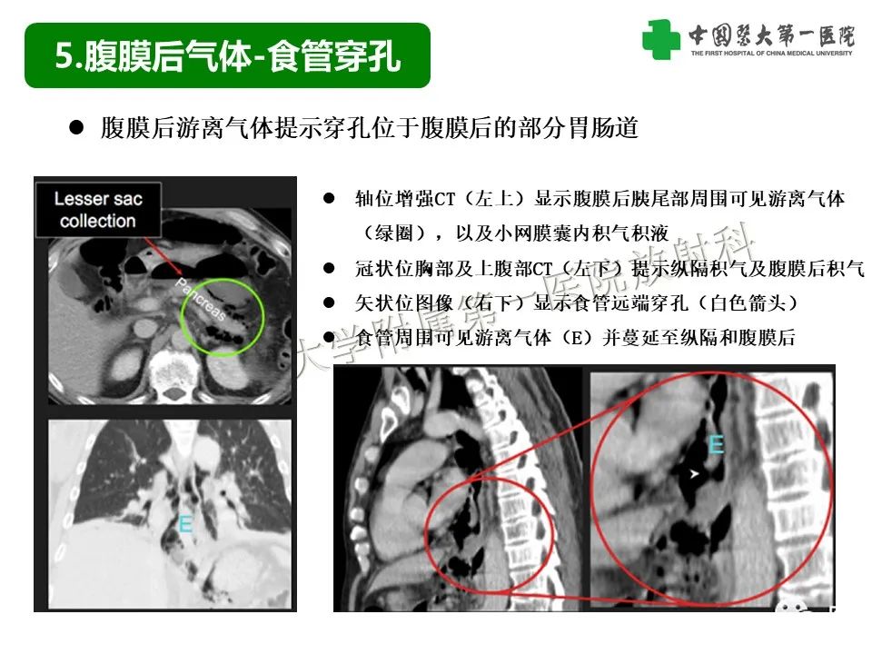影像PPT - 【PPT】腹腔内游离气体从哪来？如何根据腹膜解剖确定穿孔位置-28