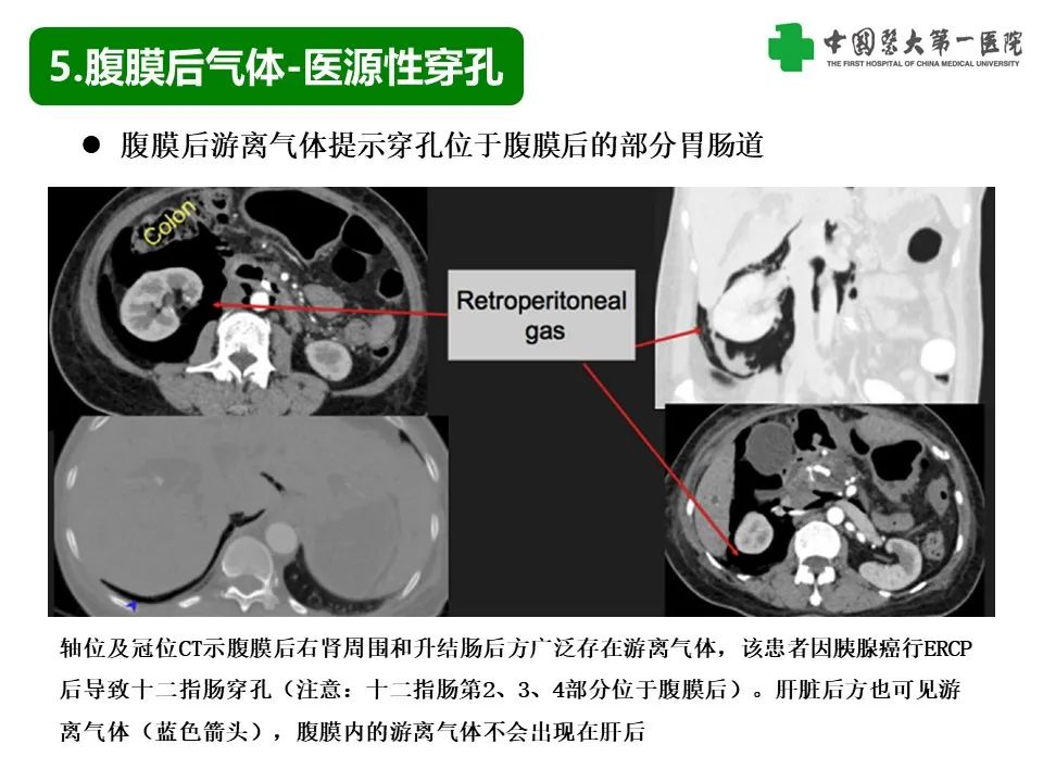 影像PPT - 【PPT】腹腔内游离气体从哪来？如何根据腹膜解剖确定穿孔位置-30