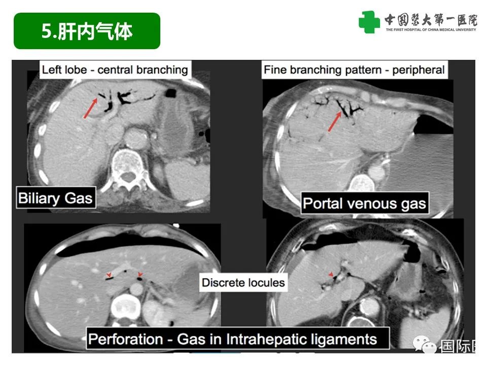 影像PPT - 【PPT】腹腔内游离气体从哪来？如何根据腹膜解剖确定穿孔位置-21