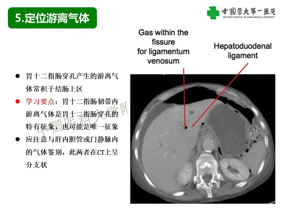 影像PPT - 【PPT】腹腔内游离气体从哪来？如何根据腹膜解剖确定穿孔位置-20