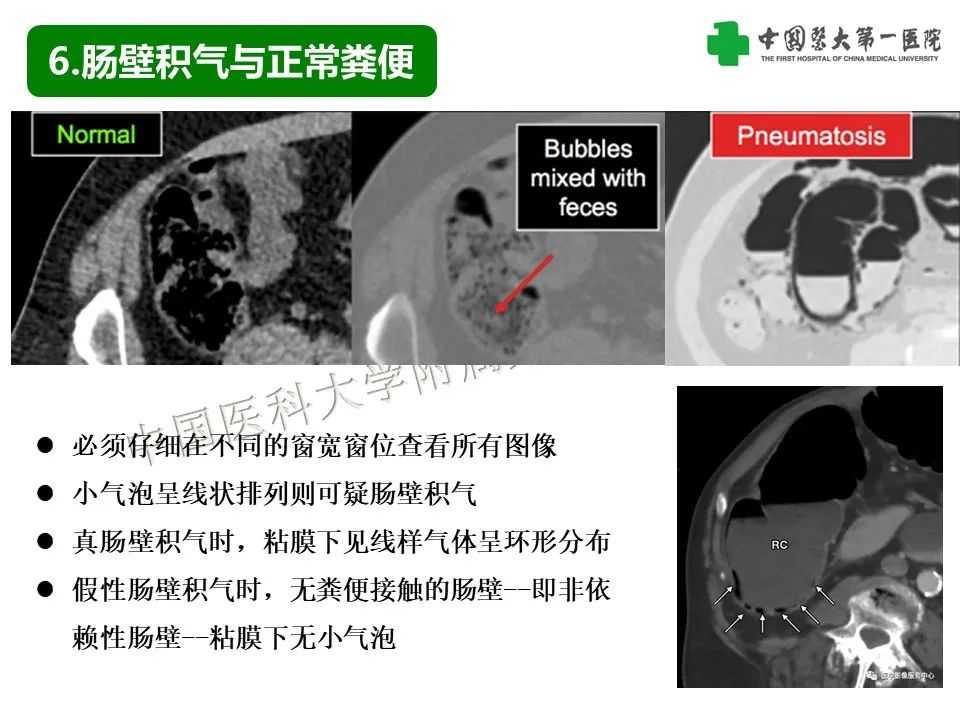影像PPT - 【PPT】腹腔内游离气体从哪来？如何根据腹膜解剖确定穿孔位置-33