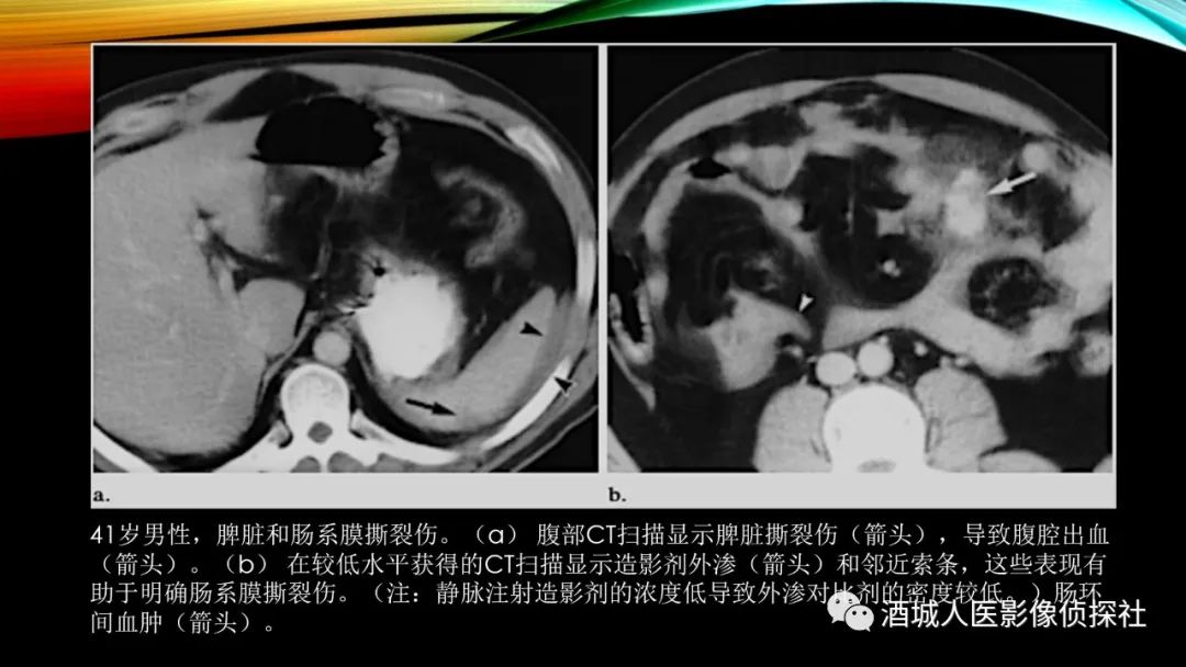 影像PPT - 【PPT】我们漏过外伤性肠系膜损伤吗？-12