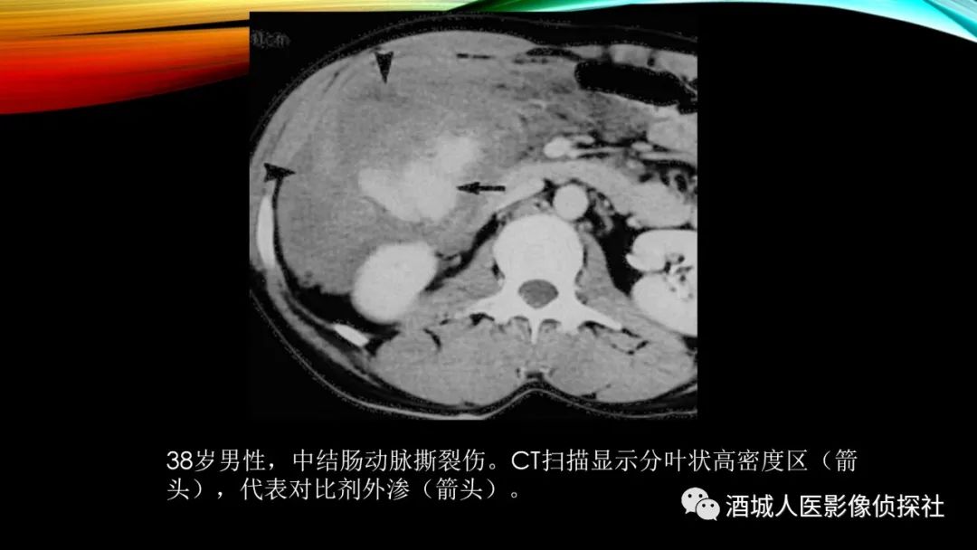 影像PPT - 【PPT】我们漏过外伤性肠系膜损伤吗？-16