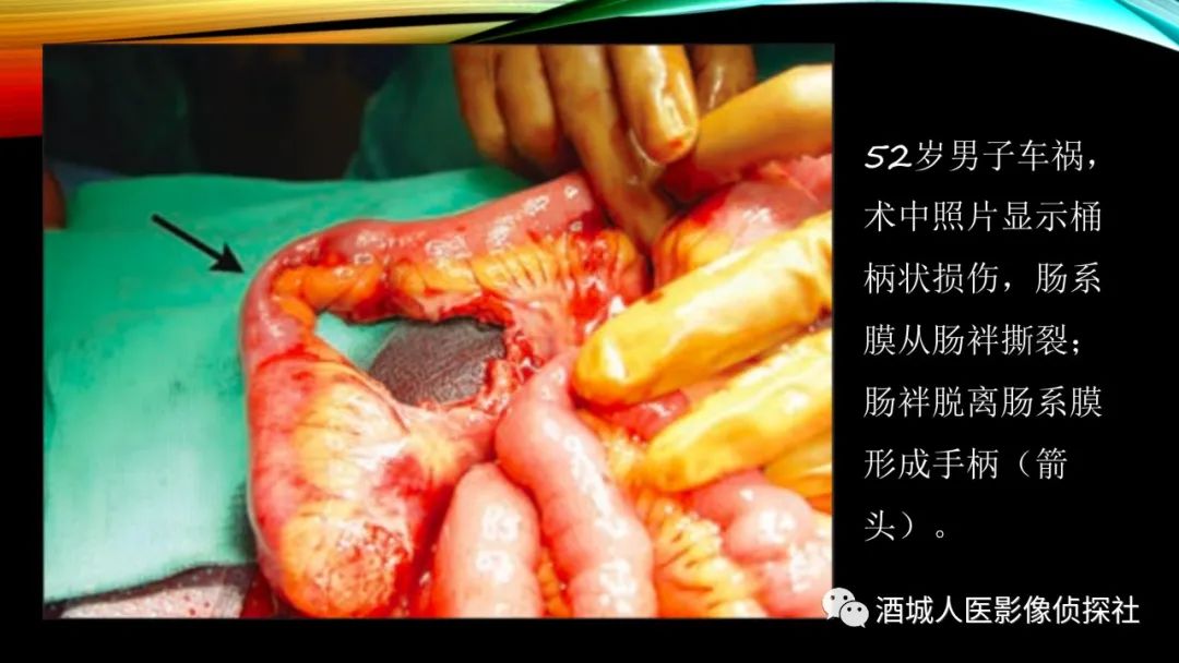 影像PPT - 【PPT】我们漏过外伤性肠系膜损伤吗？-23