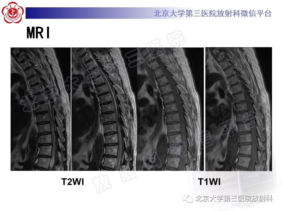 影像PPT - 【PPT】特发性肥厚性硬脊膜炎-3