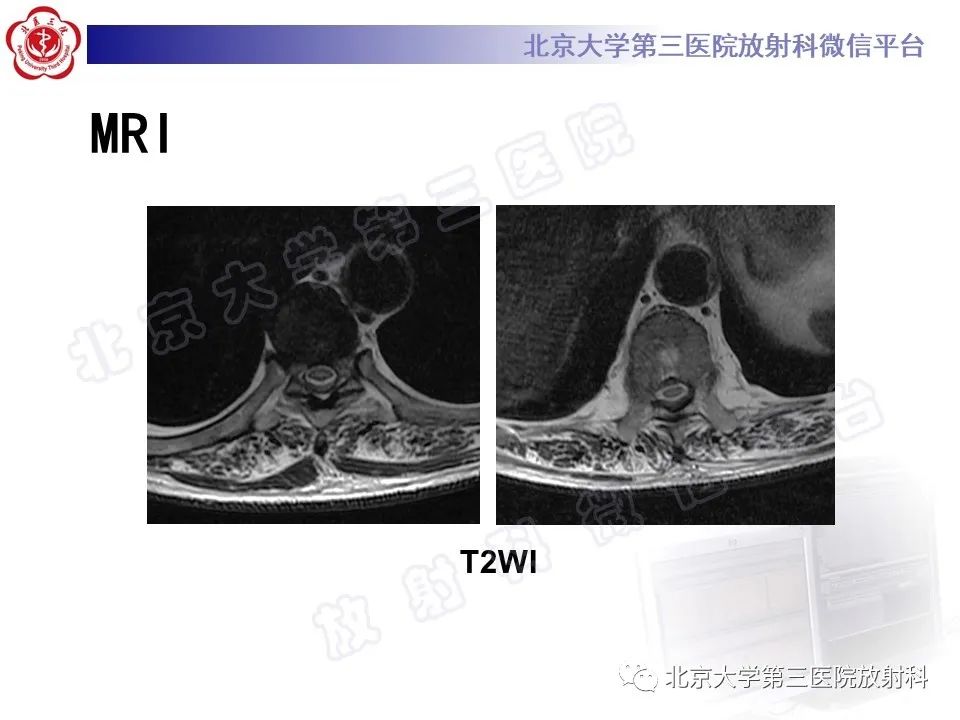 影像PPT - 【PPT】特发性肥厚性硬脊膜炎-4