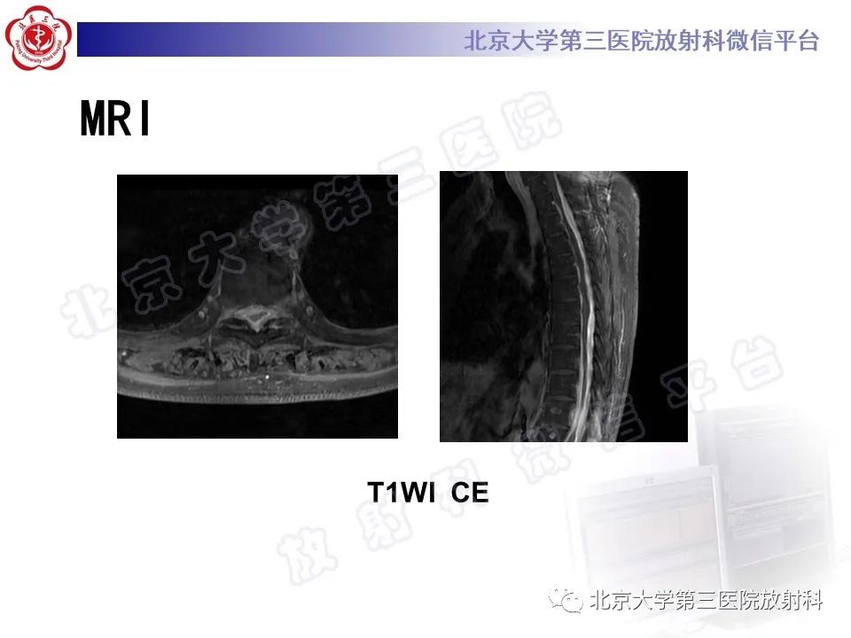 影像PPT - 【PPT】特发性肥厚性硬脊膜炎-5