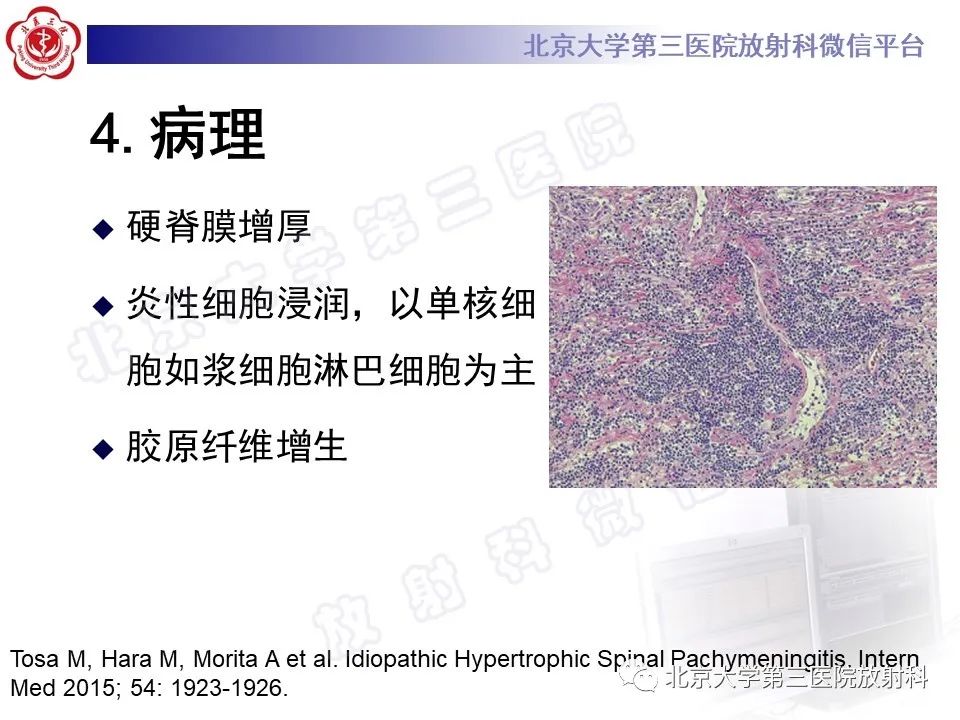 影像PPT - 【PPT】特发性肥厚性硬脊膜炎-12