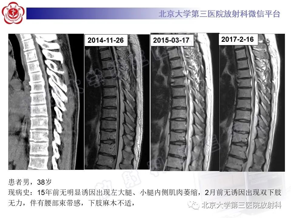 影像PPT - 【PPT】特发性肥厚性硬脊膜炎-15