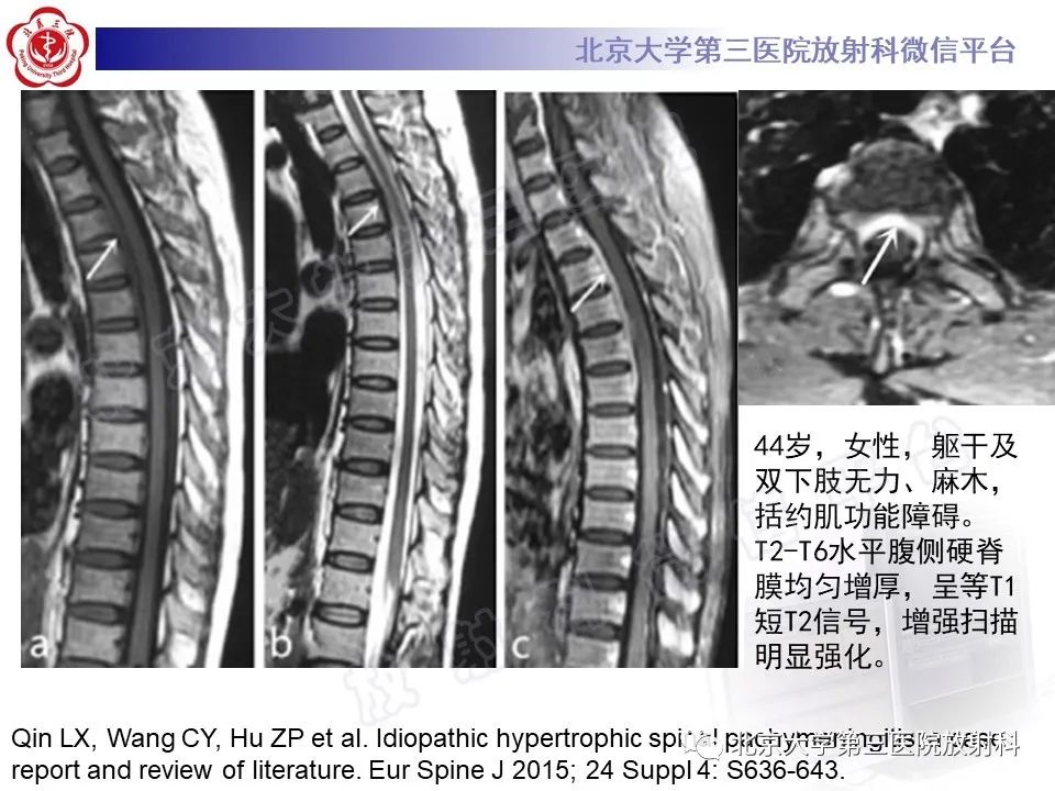 影像PPT - 【PPT】特发性肥厚性硬脊膜炎-16