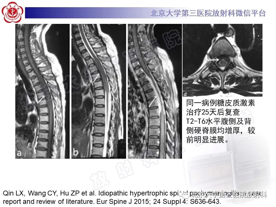 影像PPT - 【PPT】特发性肥厚性硬脊膜炎-17