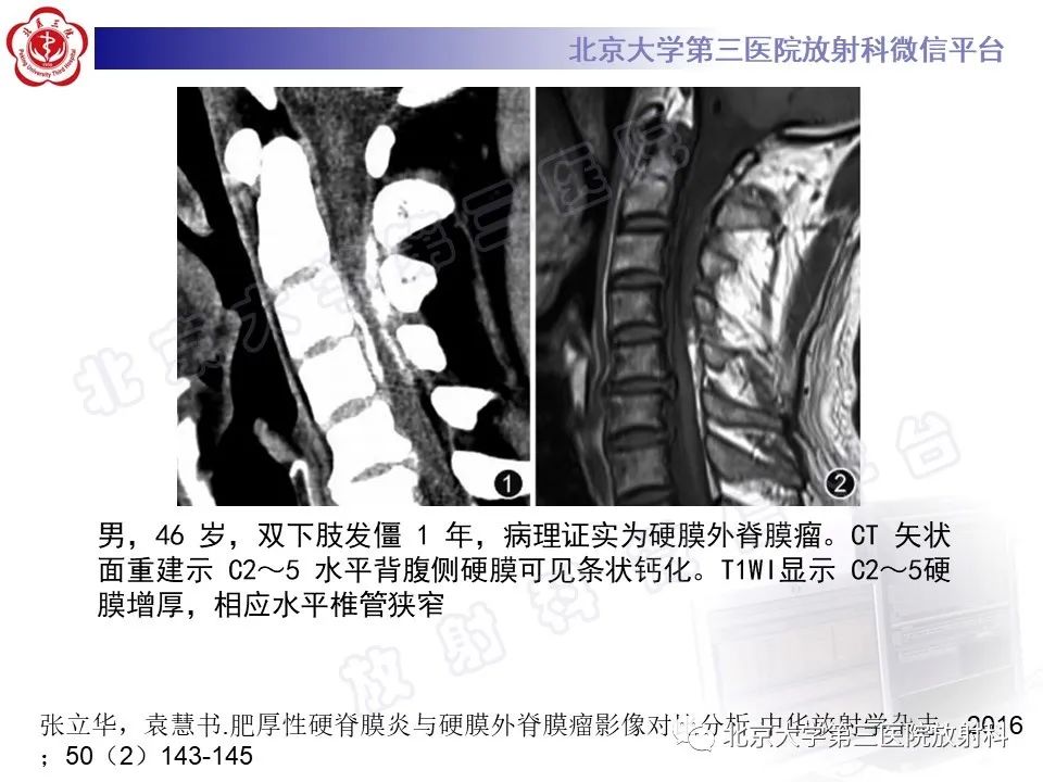 影像PPT - 【PPT】特发性肥厚性硬脊膜炎-19