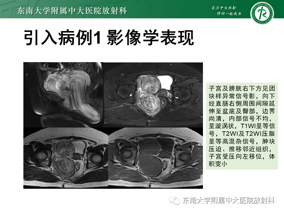 影像PPT - 【PPT】侵袭性血管黏液瘤-2