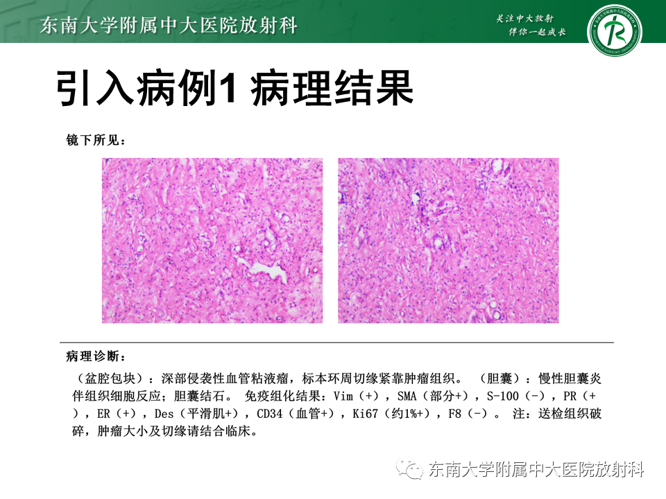 影像PPT - 【PPT】侵袭性血管黏液瘤-3