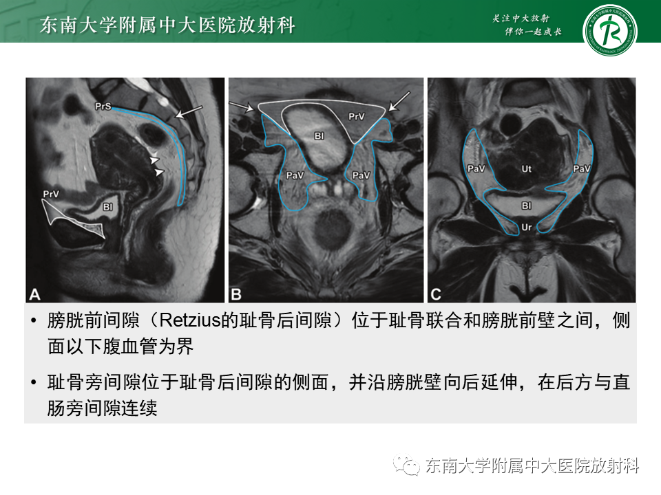 影像PPT - 【PPT】侵袭性血管黏液瘤-6