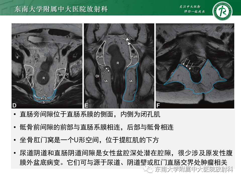 影像PPT - 【PPT】侵袭性血管黏液瘤-7