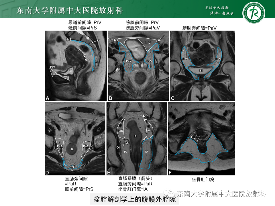 影像PPT - 【PPT】侵袭性血管黏液瘤-8