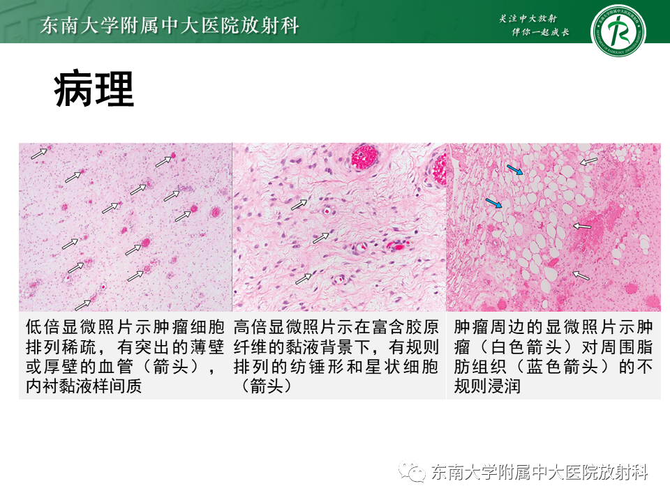 影像PPT - 【PPT】侵袭性血管黏液瘤-11