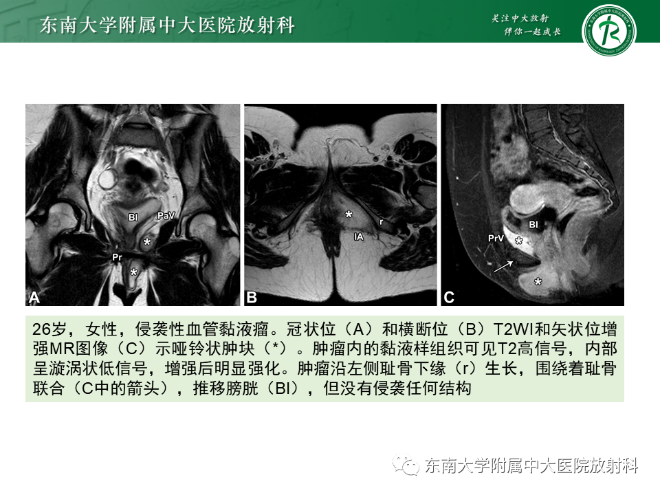 影像PPT - 【PPT】侵袭性血管黏液瘤-13