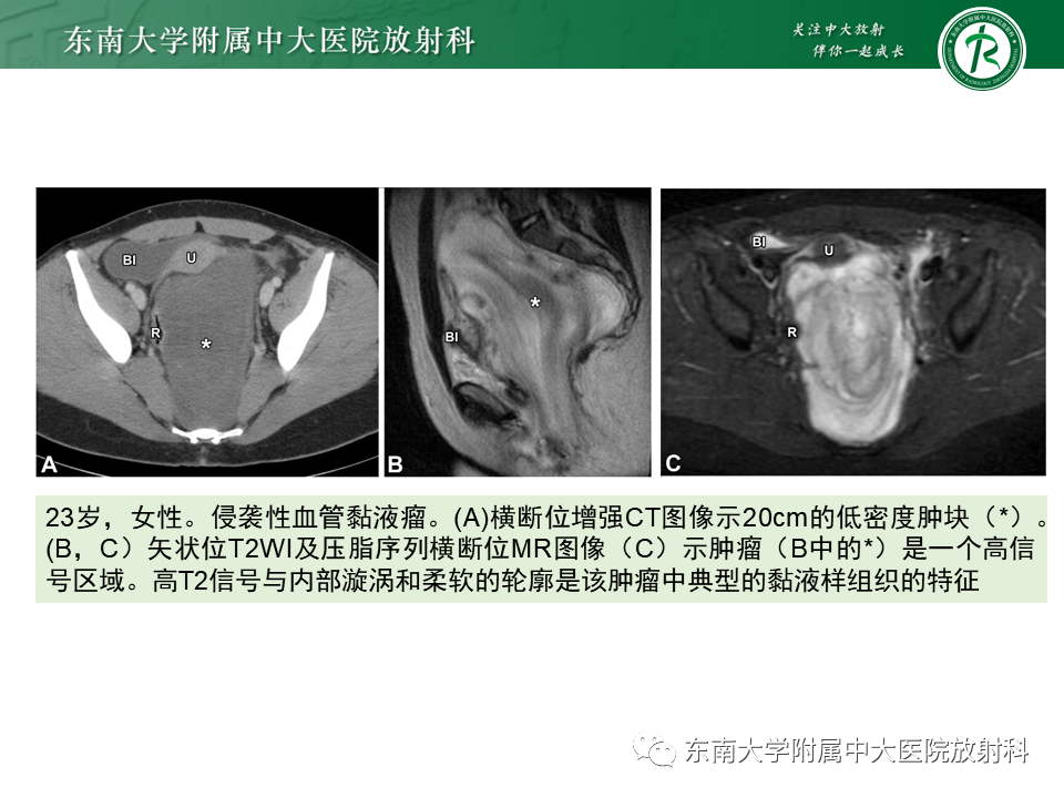 影像PPT - 【PPT】侵袭性血管黏液瘤-14