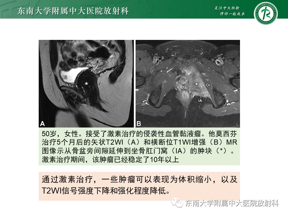 影像PPT - 【PPT】侵袭性血管黏液瘤-16