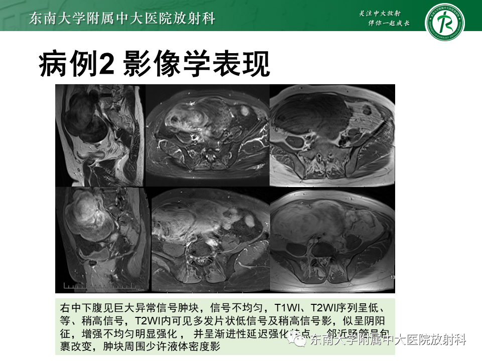 影像PPT - 【PPT】侵袭性血管黏液瘤-21