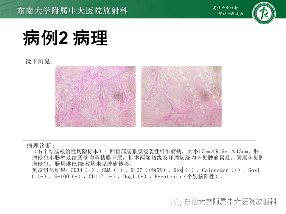 影像PPT - 【PPT】侵袭性血管黏液瘤-22