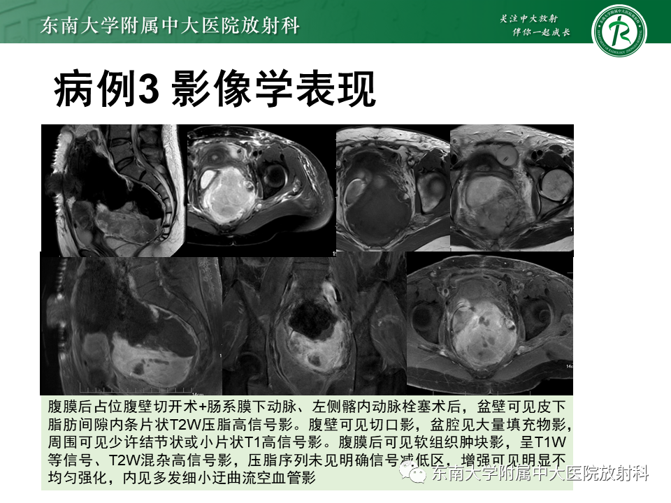 影像PPT - 【PPT】侵袭性血管黏液瘤-26