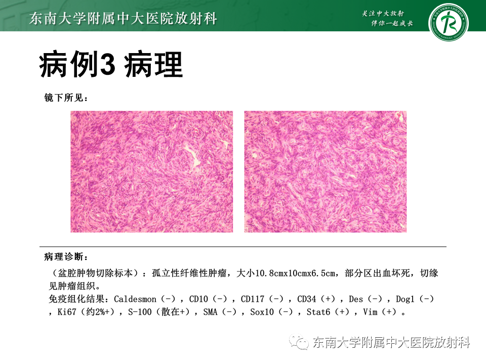 影像PPT - 【PPT】侵袭性血管黏液瘤-27