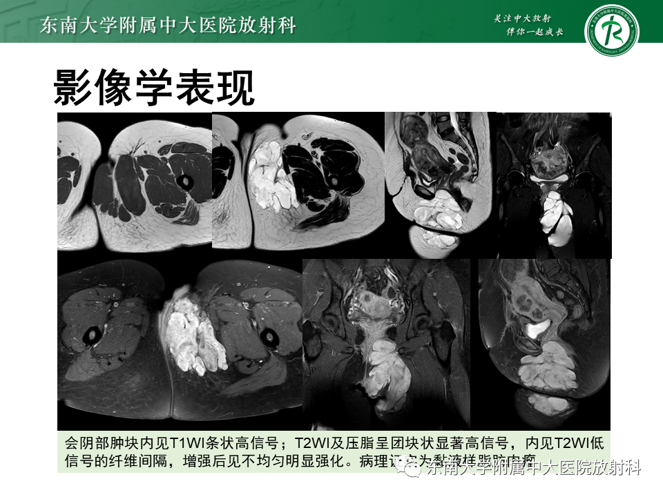 影像PPT - 【PPT】侵袭性血管黏液瘤-31