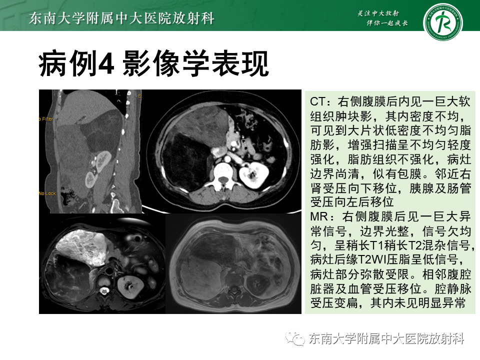 影像PPT - 【PPT】侵袭性血管黏液瘤-33